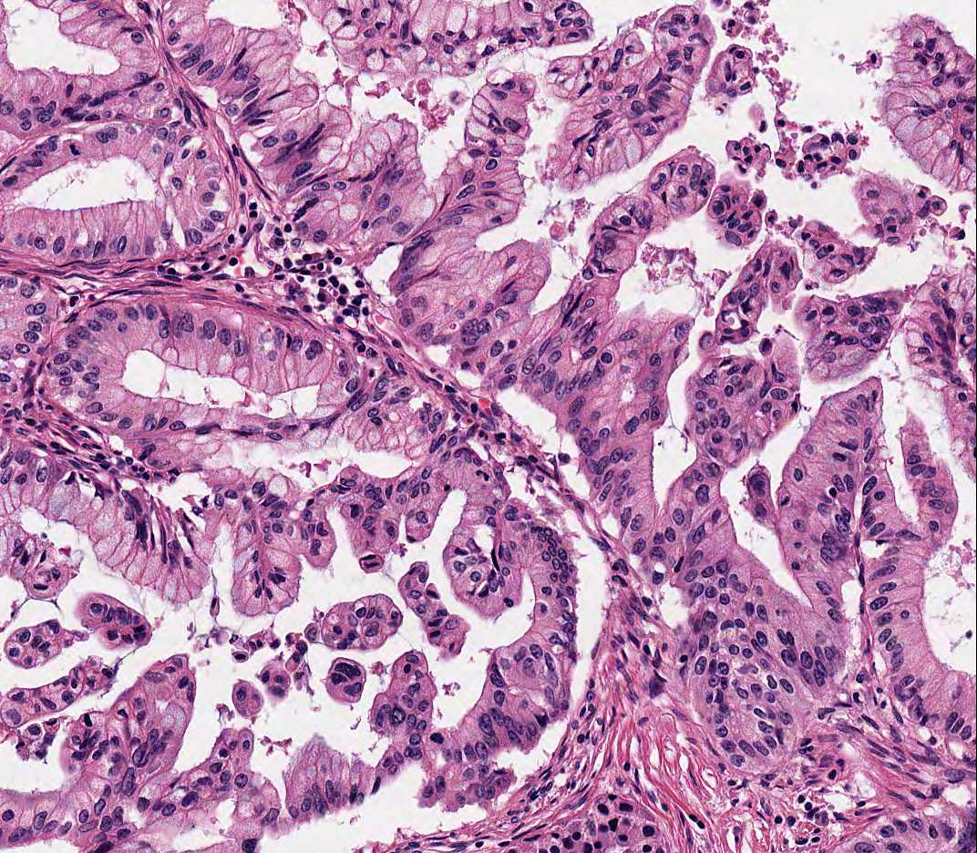 Figure 1e. PB type IPMN (HE, x200).jpg