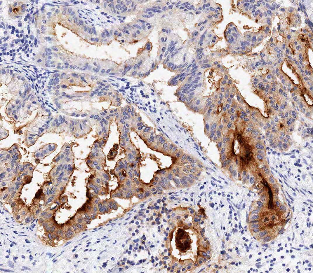 Figure 1f. PB type IPMN (MUC1, x200).jpg